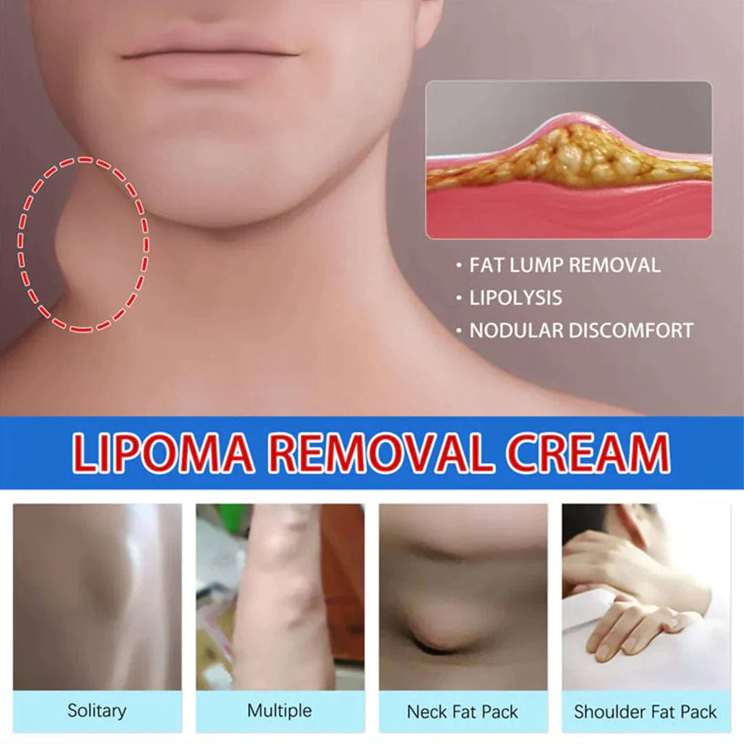 Herbal Lipoma Removal Cream (Buy 1 Get 1 Free)